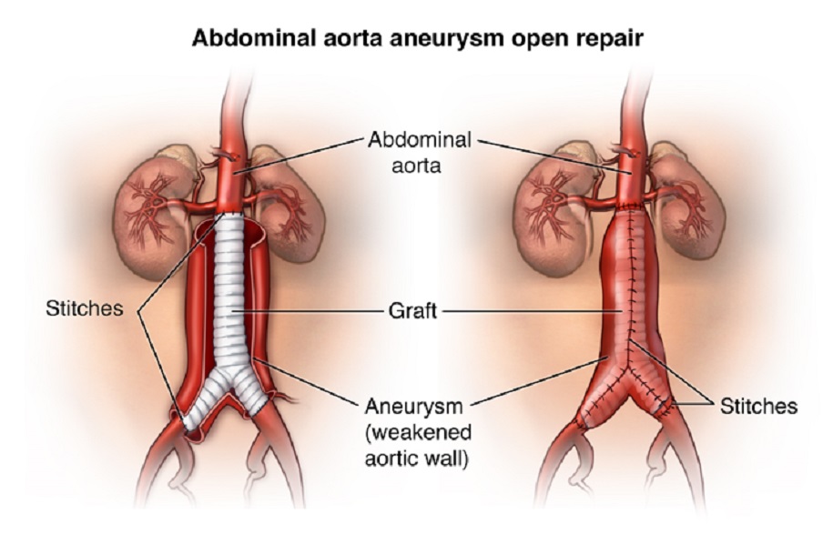 best aortic aneurysm surgeon in Ludhiana