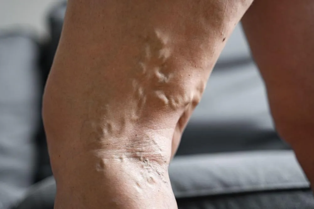 Deep Vein Thrombosis specialist in Ludhiana